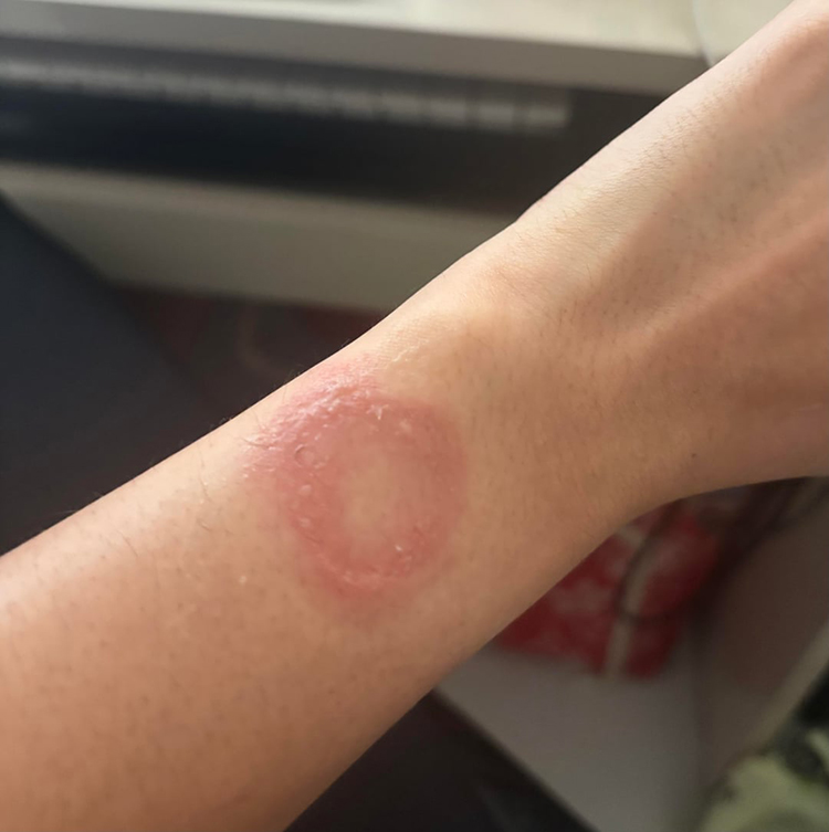  苹果手表竟会灼伤手腕？印度用户被客服踢皮球半年，准备起诉